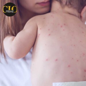 Read more about the article Two New Measles Cases Confirmed in Colorado